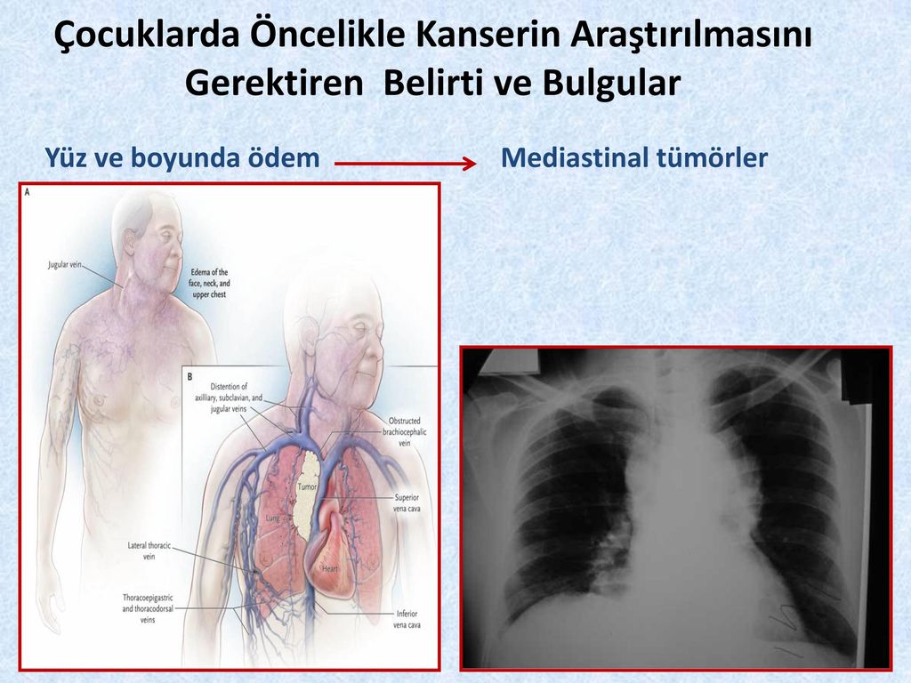 Ocukluk A I Kanserler Nde Bel Rt Ve Bulgular Ppt Indir